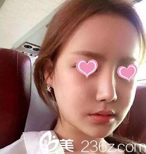 自體脂肪豐鼻唇溝后20天