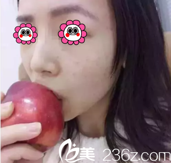 高艷醫(yī)生給我注射第12天效果