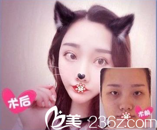 貴陽美貝爾侯舍予雙眼皮案例