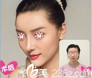 貴陽美貝爾侯舍予隆鼻前后效果對比
