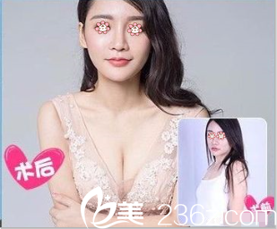 貴陽美貝爾侯舍予自體脂肪豐胸案例