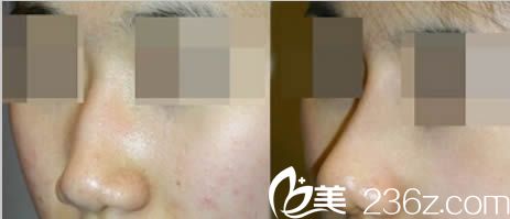 烏魯木齊伊麗莎白整形醫(yī)院假體隆鼻效果對(duì)比圖
