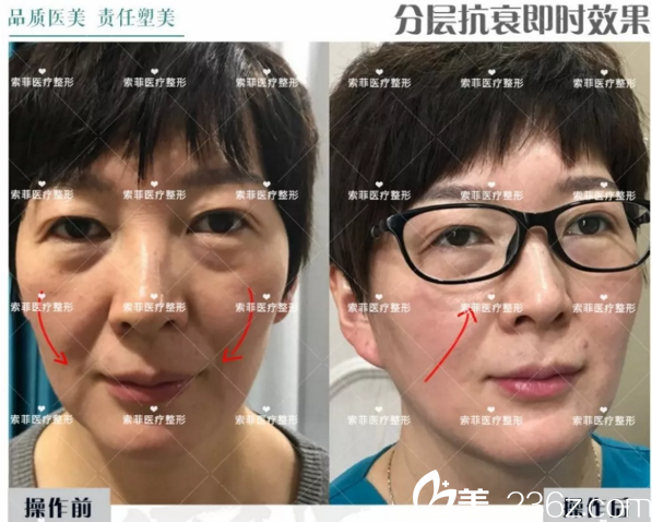 博瑞萊前后對比