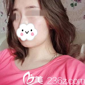 埋線提升前的我 埋線提升前的我