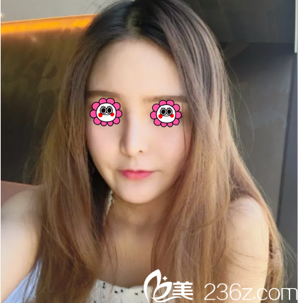 北京印正山<!--<i data=20240703-sp></i>-->給我做面部脂肪填充第13天效果 北京印正山<!--<i data=20240703-sp></i>-->給我做面部脂肪填充第13天效果