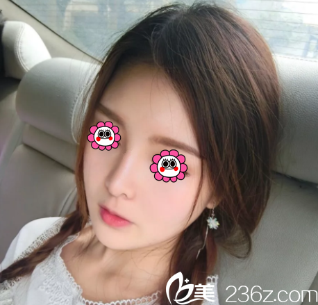 在北京印正山做面部脂肪填充三個(gè)月效果 在北京印正山做面部脂肪填充三個(gè)月效果