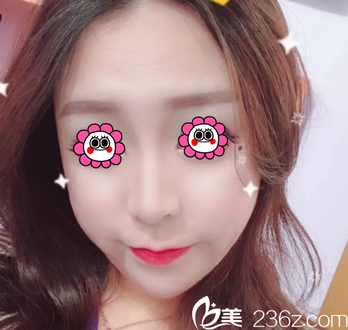 給你看我在北京印正山做自體脂肪面部填充前后對(duì)比效果好么