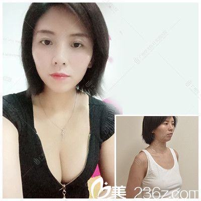 廣州華美曾高做的隆胸案例