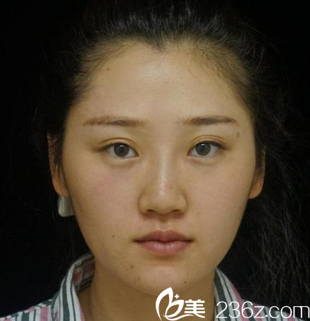 在廣州華美做隆鼻手術(shù)前 在廣州華美做隆鼻手術(shù)前