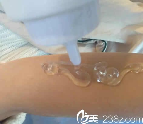 我在太原歐美蓮整形做激光脫毛術(shù)中 我在太原歐美蓮整形做激光脫毛術(shù)中