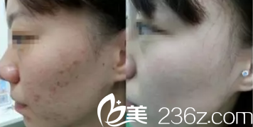 激光祛痘案例