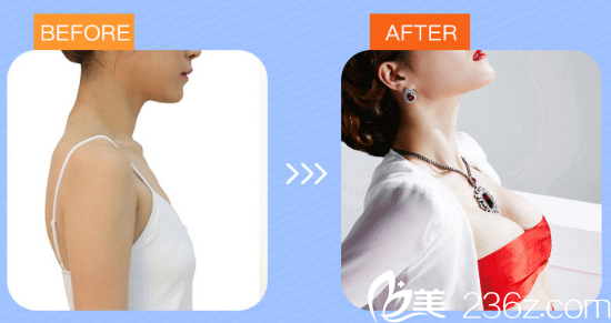 湛江澳泰整形醫(yī)院張維華做的隆胸案例