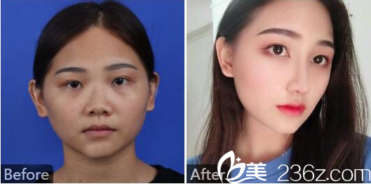 湛江澳泰整形醫(yī)院張維華隆鼻案例圖