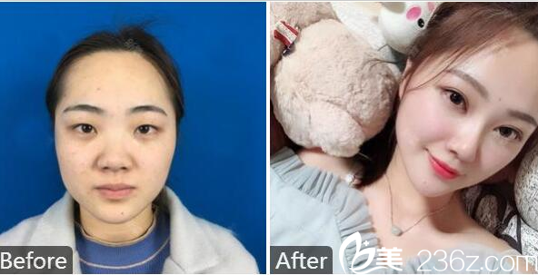 湛江澳泰整形醫(yī)院張維華做的雙眼皮案例