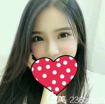 張維華做的雙眼皮隆鼻術(shù)后7天