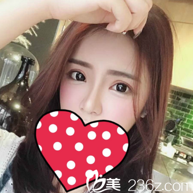 湛江澳泰整形醫(yī)院雙眼皮隆鼻脂肪填充案例圖