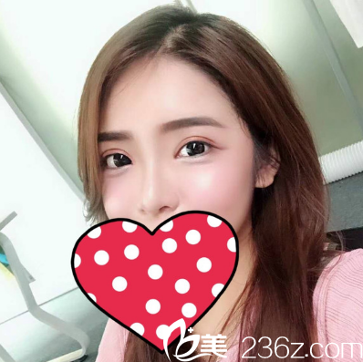 我的雙眼皮和隆鼻是找湛江澳泰整形醫(yī)院張維華做的超級好看