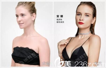 瑞韓寶島荔枝高端假體娜琦麗隆胸真人案例