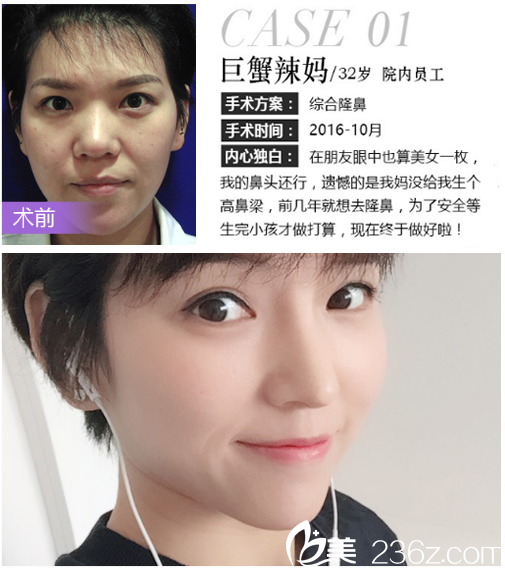 深圳米蘭柏羽朱根武做的肋軟骨隆鼻案例 深圳米蘭柏羽朱根武做的肋軟骨隆鼻案例