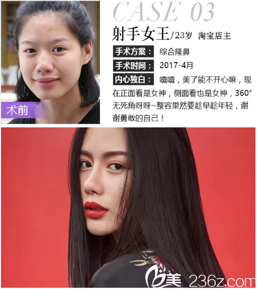 深圳米蘭柏羽王志東做的隆鼻案例 深圳米蘭柏羽王志東做的隆鼻案例