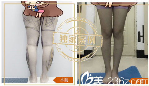 深圳米蘭柏羽王志東大腿吸脂案例對比圖 深圳米蘭柏羽王志東大腿吸脂案例對比圖