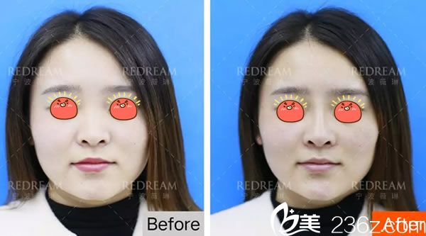 寧波薇琳曾舉公主玻尿酸注射<span style= 寧波薇琳曾舉公主玻尿酸注射<span style=