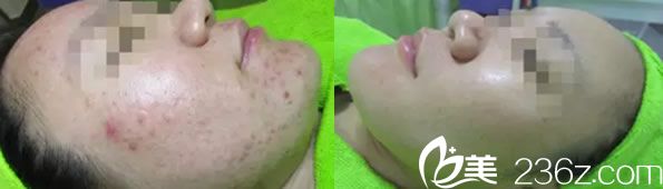 周玲院長治療祛痘效果對比案例