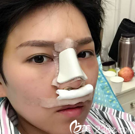 深圳米蘭柏羽晶鉆隆鼻案例第二天