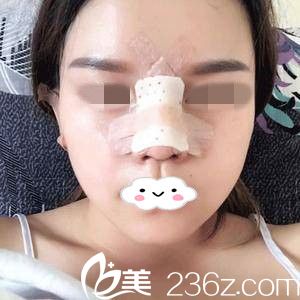 隆鼻術(shù)后第三天 隆鼻術(shù)后第三天