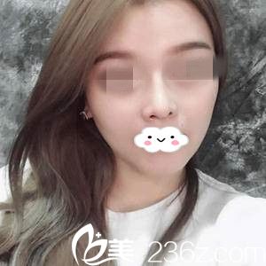 慕名而來(lái)終于預(yù)約到了游鵬飛醫(yī)生定制隆鼻，20天后真的是超級(jí)滿意