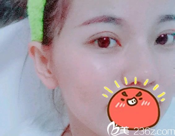 做完雙眼皮開眼角綜合手術(shù)15天效果