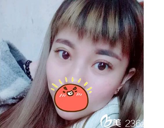 來看看我剛找臺州博仕整形張永繼院長做的芭比眼綜合效果，個人覺得還不賴