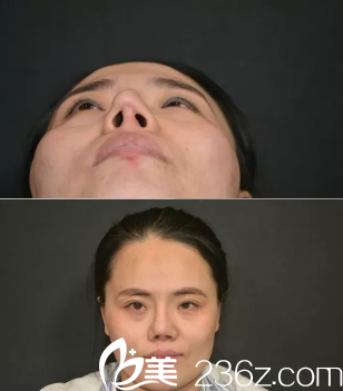 分享我在濟(jì)南美蓮做的鼻修復(fù)術(shù)前照片 分享我在濟(jì)南美蓮做的鼻修復(fù)術(shù)前照片