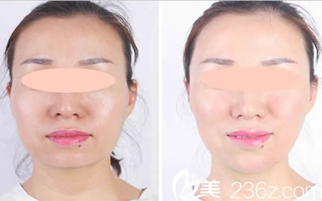 唐山蘇亞美聯(lián)臣面部輪廓效果對(duì)比圖