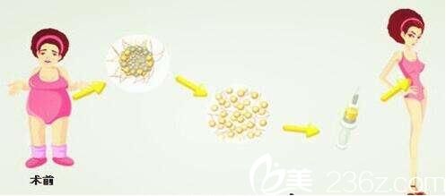 瘦子可以做自體脂肪隆胸嗎?