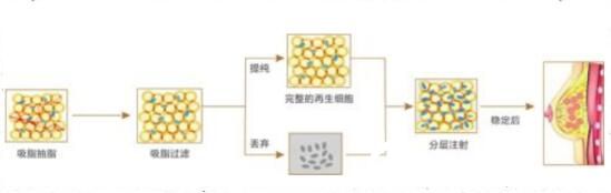 瘦人做自體脂肪隆胸會不會成活率低
