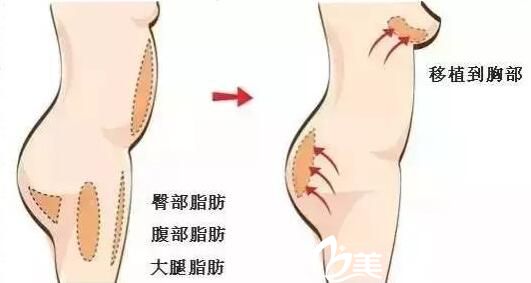  自體脂肪隆胸是怎么做的?