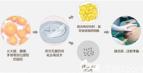 自體脂肪移植隆胸手感好嗎?