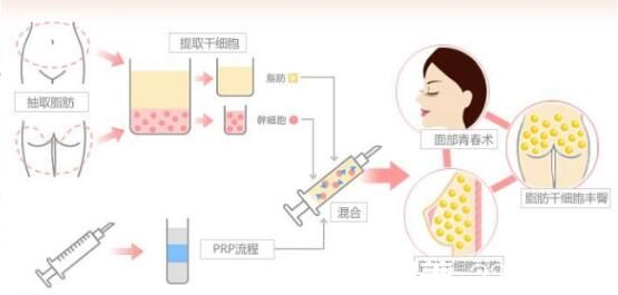  自體脂肪吸收率好不好？
