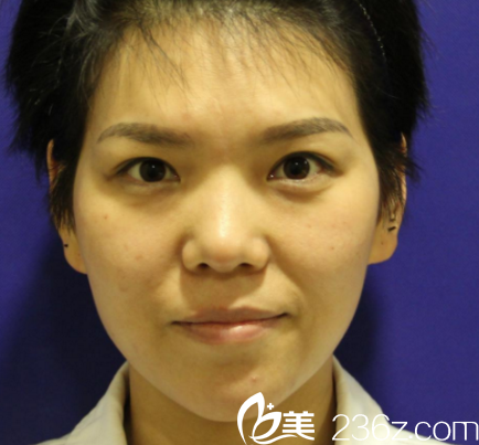 進(jìn)來(lái)剛在西安做的鼻綜合手術(shù) 進(jìn)來(lái)剛在西安做的鼻綜合手術(shù)