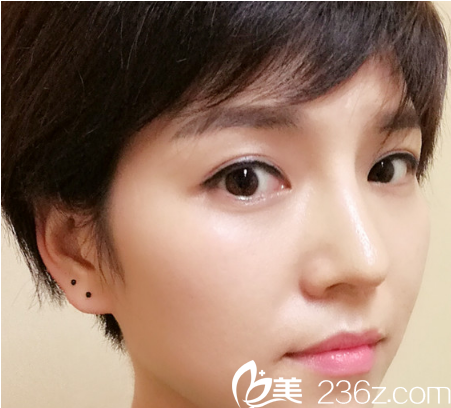 術(shù)后的樣子 術(shù)后的樣子