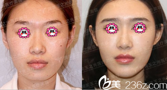 王明利面部脂肪填充案例