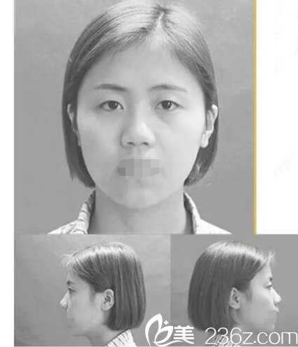 術(shù)前三角眼塌鼻子 術(shù)前三角眼塌鼻子