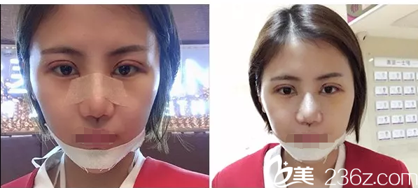 做完雙眼皮+隆鼻術(shù)后三天 做完雙眼皮+隆鼻術(shù)后三天