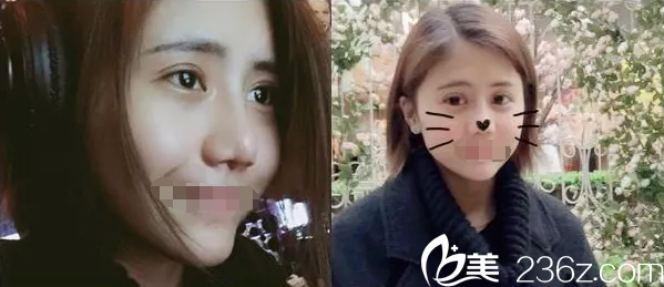 做完雙眼皮+假體隆鼻術(shù)后一月恢復(fù) 做完雙眼皮+假體隆鼻術(shù)后一月恢復(fù)