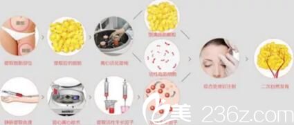 自體脂肪豐額頭脂肪提取過程