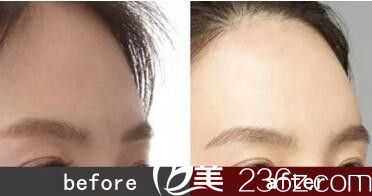 自體脂肪豐額頭前后真人效果展示