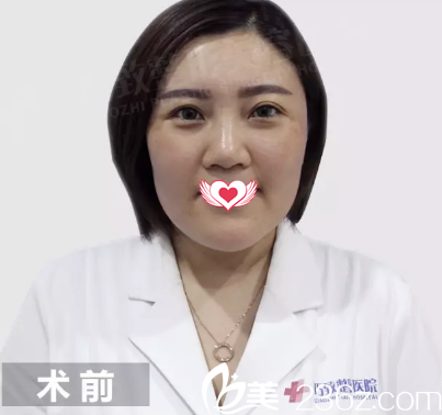 術(shù)前面部皮膚松弛下垂 術(shù)前面部皮膚松弛下垂