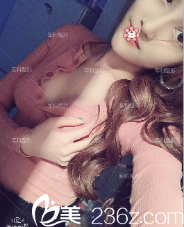 重慶軍科趙亞均假體隆胸術(shù)后一個月