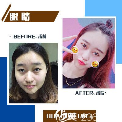 東莞維多利亞整形醫(yī)院雙眼皮效果圖 東莞維多利亞整形醫(yī)院雙眼皮效果圖